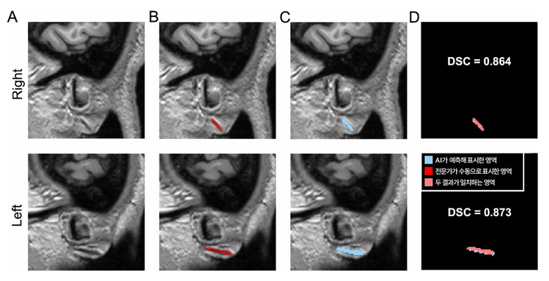 분당서울대병원 "귓불 주름으로 뇌혈관...
